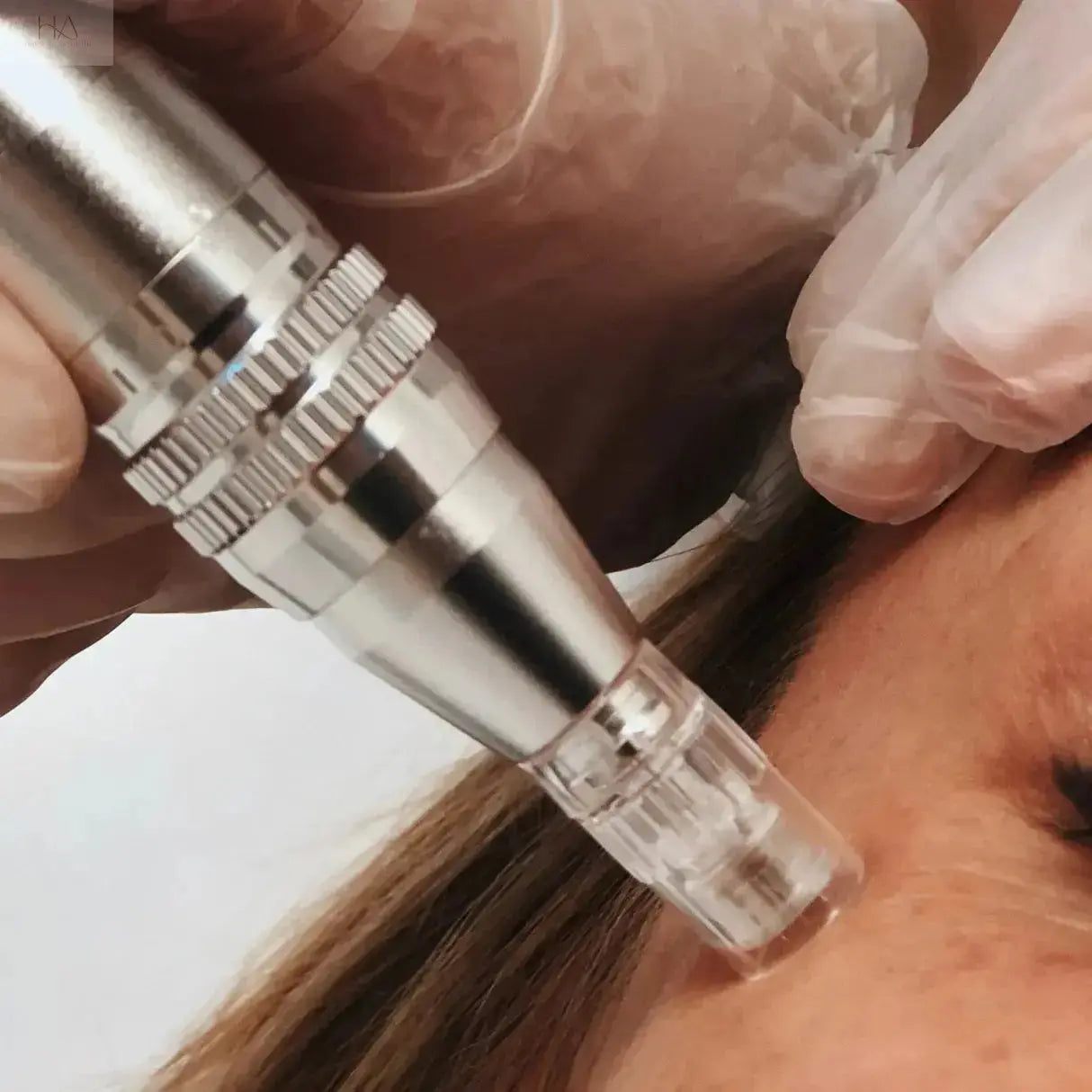 Microneedling PRP Décolletage HAUS OF ÄSTHETIK
