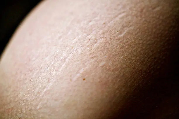 PRP Injections for Stretch Marks & Scarring HAUS OF ÄSTHETIK