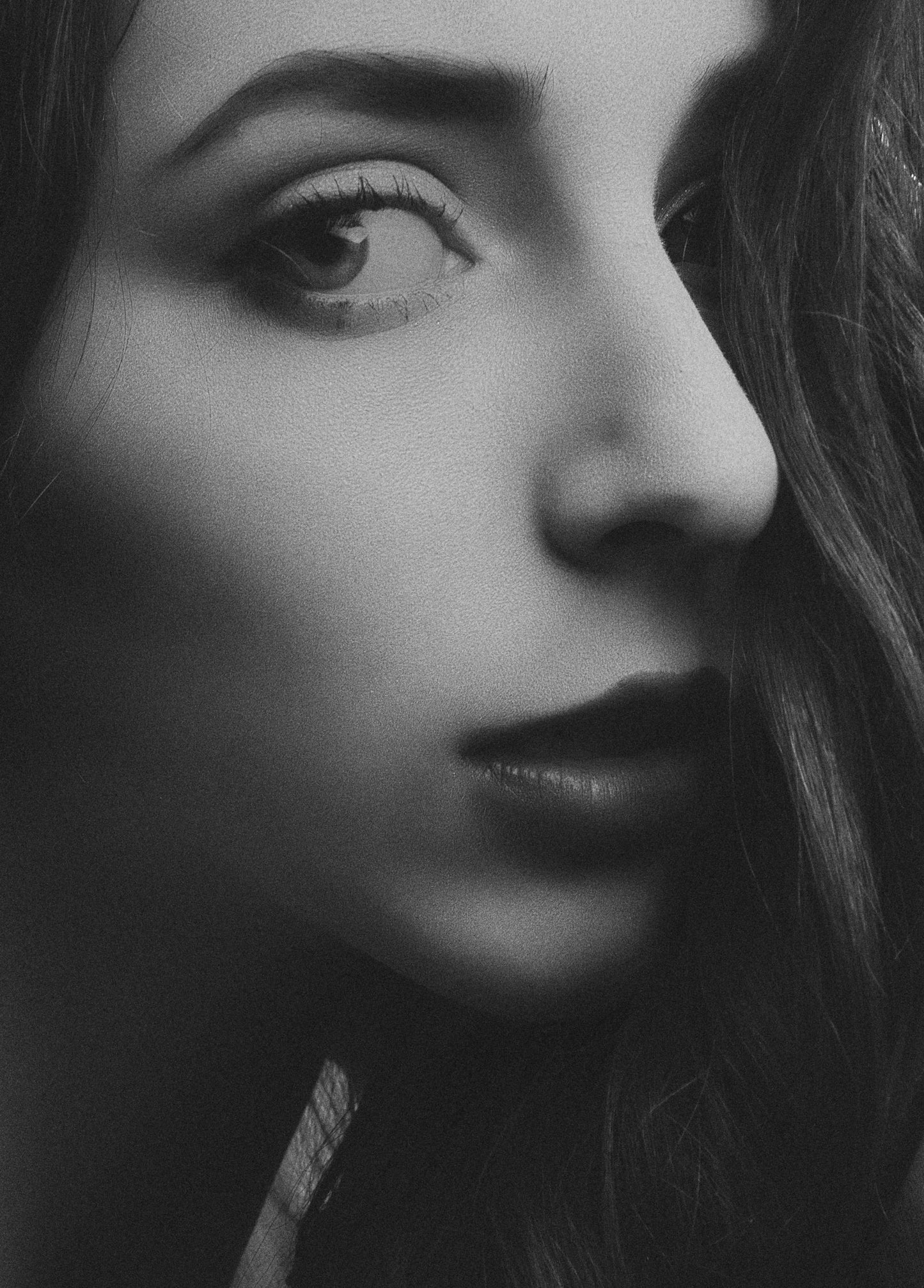 Nasal Tip Lift (Drooping Tip Correction) with Botulinum Toxin