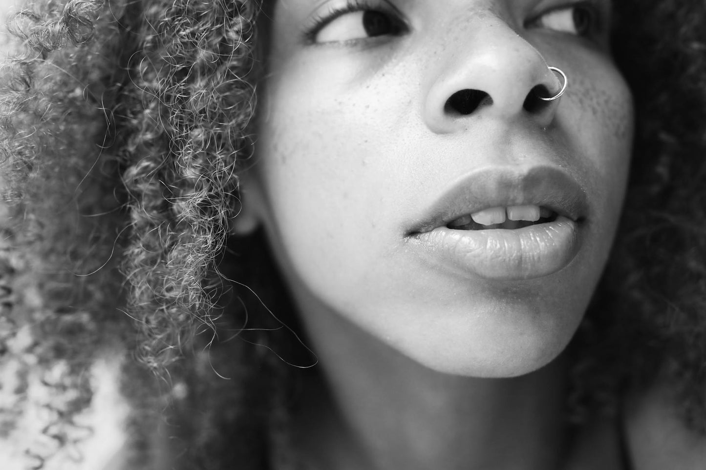 Nasal Flaring Reduction with Botulinum Toxin