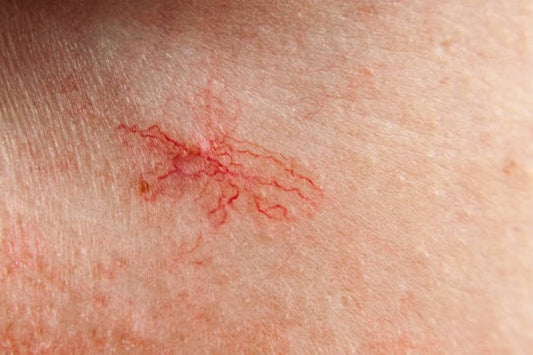 Sclerotherapy